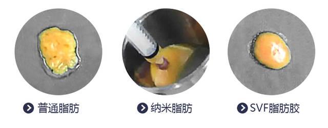 svf脂肪胶填充和普通填充的区别