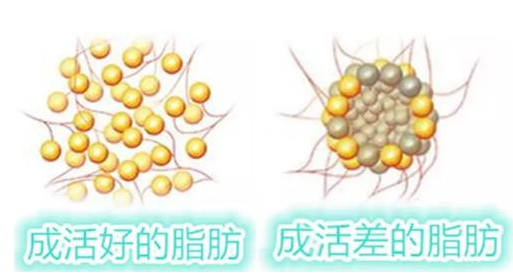 于海生医生科普面部脂肪填充手术