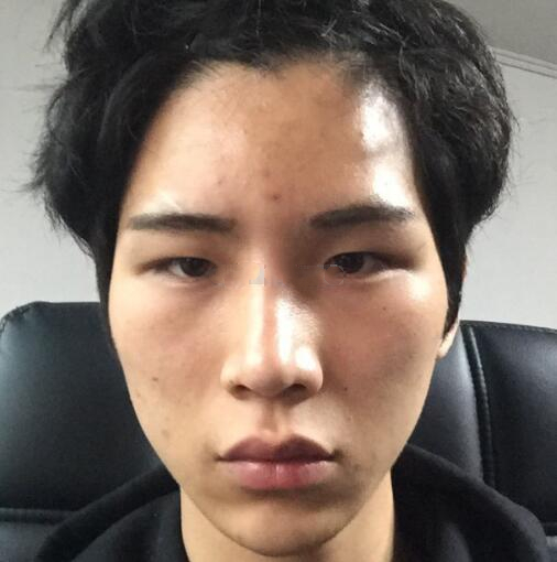 男生颧骨颧弓整形亲测体验分享，精致男人硬朗不失美感！