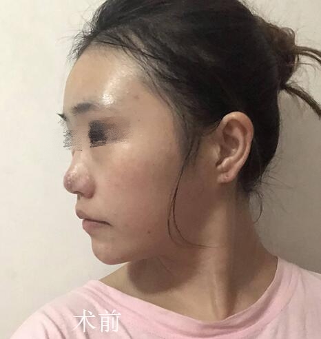 深圳江南春天医疗美容隆鼻案例分享