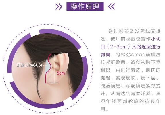 面部拉皮去皱整形