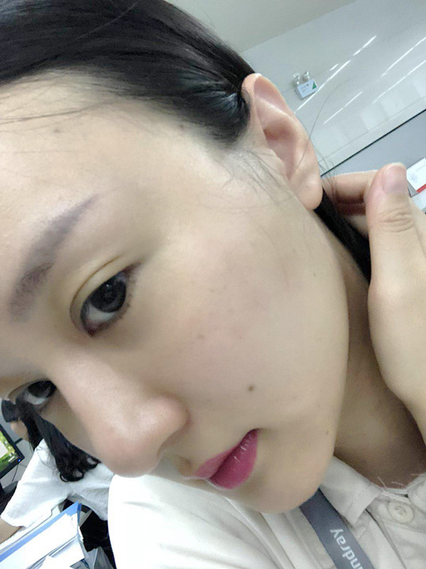 埋线面部提升手术果图