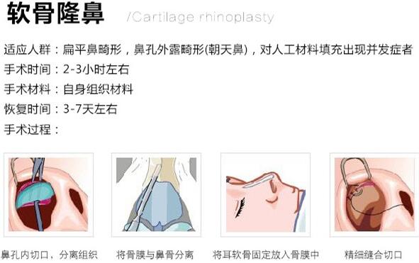 巫文云医生科普软骨隆鼻手术