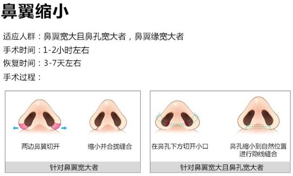 鼻翼变小别让大鼻头“毁”了全部鼻部
