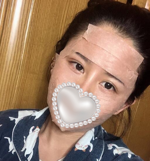 svf脂肪胶填充体验案例果