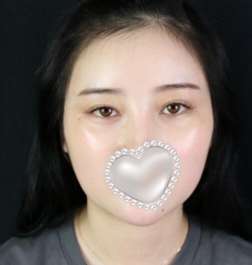 面部吸脂瘦脸手术果对比