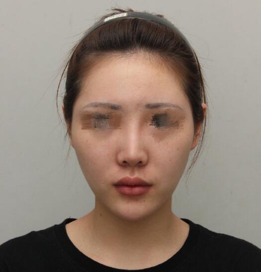 做歪鼻矫正果图分享