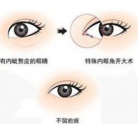 开外眼角适合人群是哪些，好看吗？超全科普+果图对比为你整理！