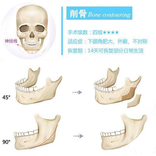 崔荣达医生科普磨骨和削骨有哪些区别