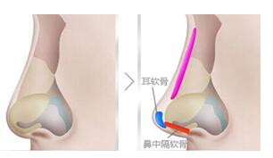 赵新峰医生科普做鼻子手术