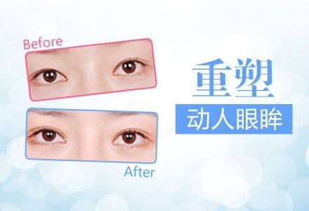 韩勋医生介绍双眼皮修复手术