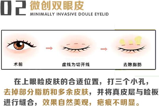 赵延勇医生科普双眼皮