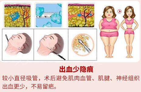 八大处美容整形科普腰腹吸脂手术