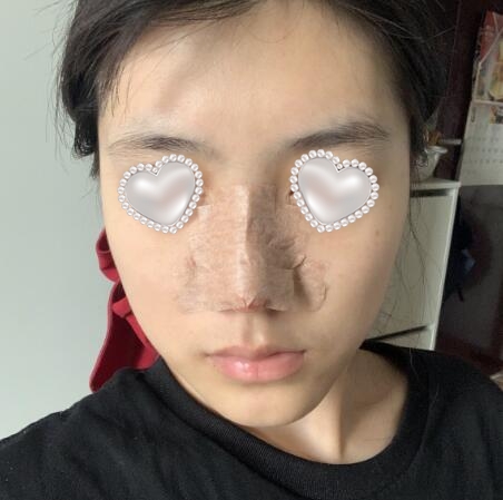 武汉伽美医疗美容隆鼻案例分享