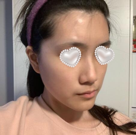 武汉伽美医疗美容隆鼻案例分享