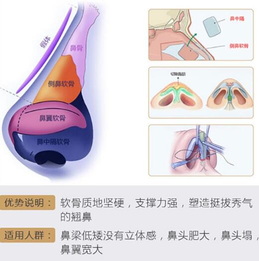 中山一院整形科科普什么是自体软骨隆鼻