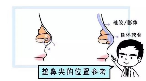 鼻尖整形手术科普