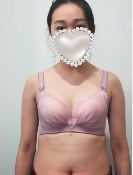 滨州医学院附属医院吸脂案例分享