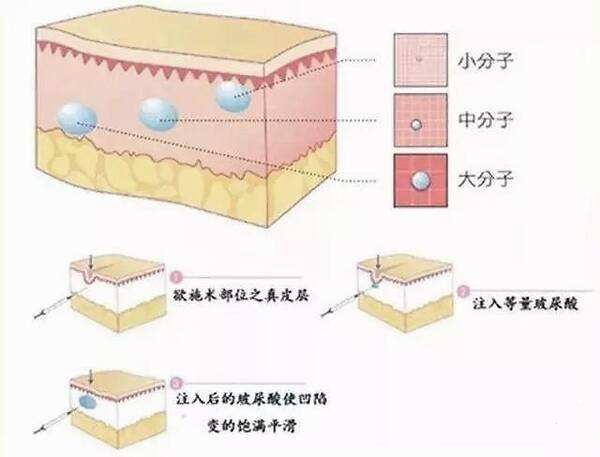 玻尿酸填充泪沟注意事项