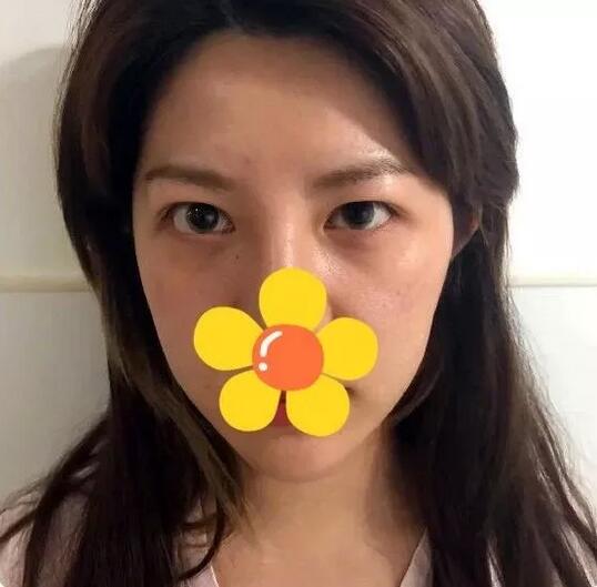 权柳京医生双眼皮案例分享