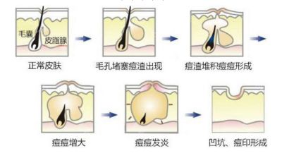 长痘痘留下的坑怎么办