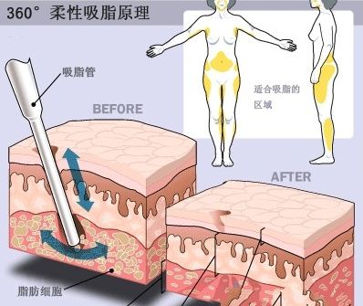 韩岩医生科普吸脂手术