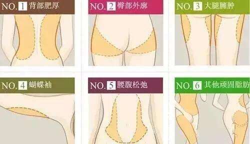 萍乡丽芙整形医院科普吸脂减肥