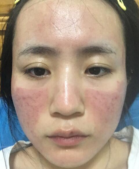 激光去除痘疤果图分享