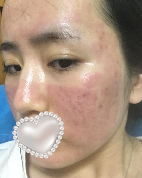 激光去除痘疤果图分享