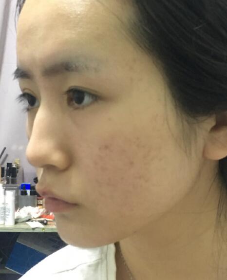 激光去除痘疤果图分享