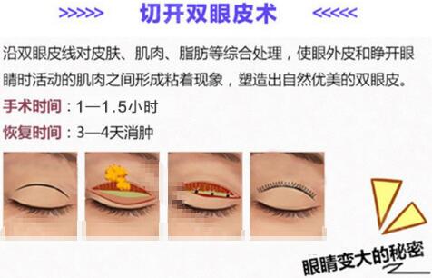 台州中心医院整形科普双眼皮手术