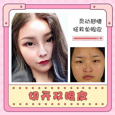 台州中心医院整形科普双眼皮手术