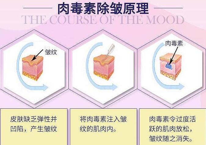 注射瘦脸注射除皱维持多久