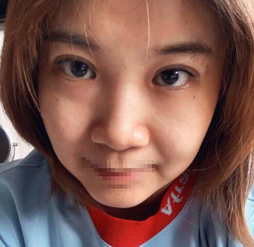 北京安贞医院双眼皮案例分享