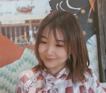 北京安贞医院双眼皮案例分享