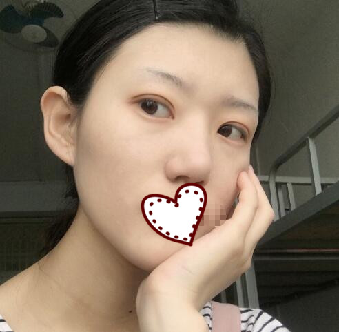 北京伊美尔医院双眼皮案例分享