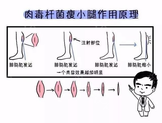 注射瘦脸注射瘦腿