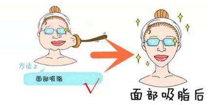 几类普遍的整瓜子脸方式