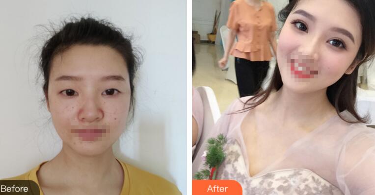 深圳鹏程整形医院双眼皮案例分享