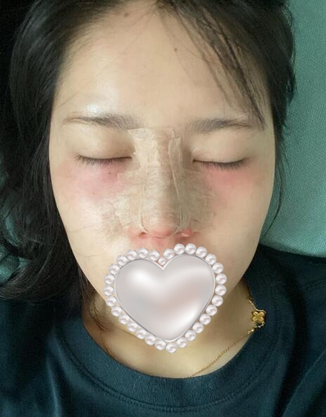 上海华美整形美容医院隆鼻案例