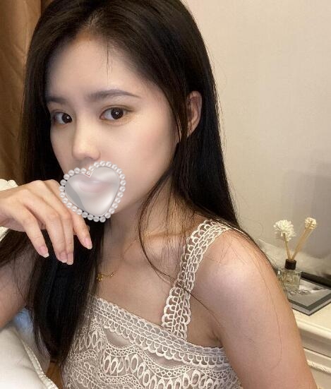 上海华美整形美容医院隆鼻案例