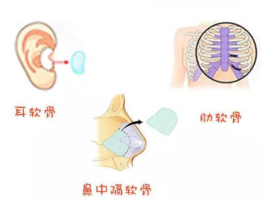 东莞知美医疗整形医院科普隆鼻方法