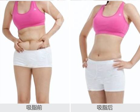 武汉美之仁整形美容医院科普腰腹吸脂