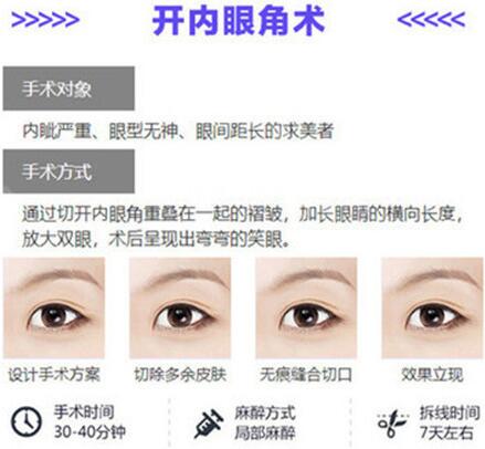 八大处宋涛医生科普双眼皮开眼角