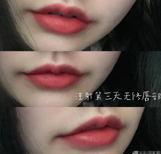 注射丰唇整形手术果图