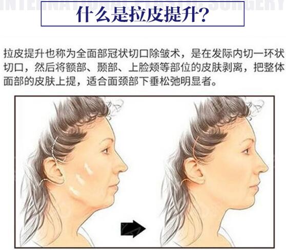 面部拉皮去皱整形