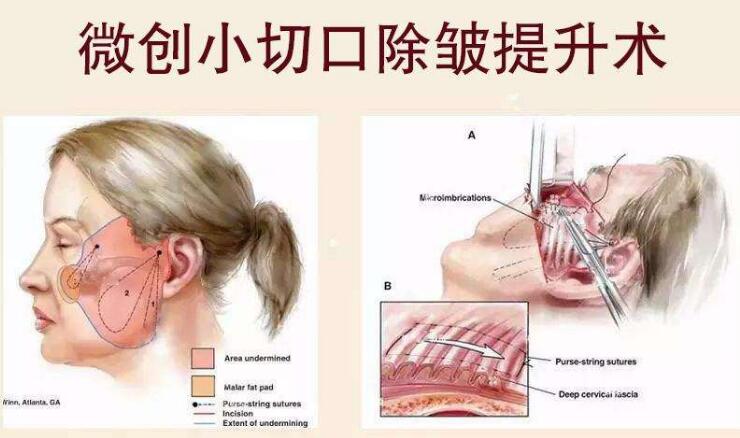 面部拉皮去皱整形