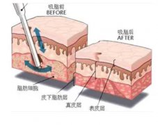 全身抽脂要多少钱？价格的高低和哪些因素有关呢？