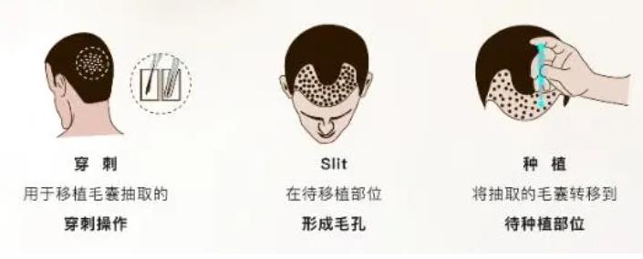 tddp植发技术