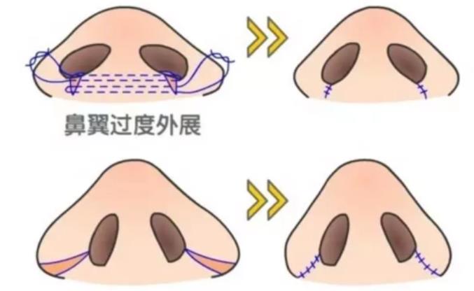 鼻头肥大动漫01.jpg 鼻头肥大动漫01.jpg